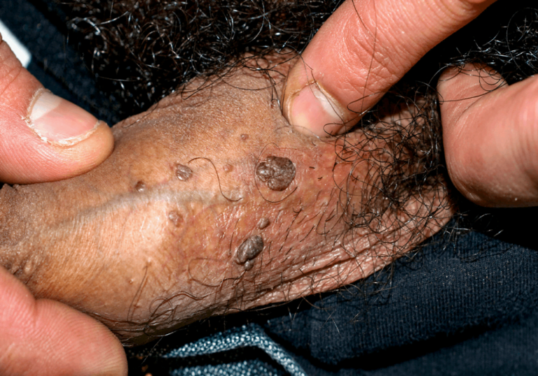 الأسئلة الشائعة حول الثأليل التناسلية