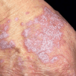 ما هو الحزاز المتصلب؟