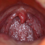 الكلاميديا الأعراض والأسباب والعلاجات