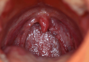 الكلاميديا الأعراض والأسباب والعلاجات