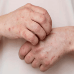 كل ما تحتاج لمعرفته حول مرض الزهري